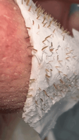 1. Cream Activated Peel Systems